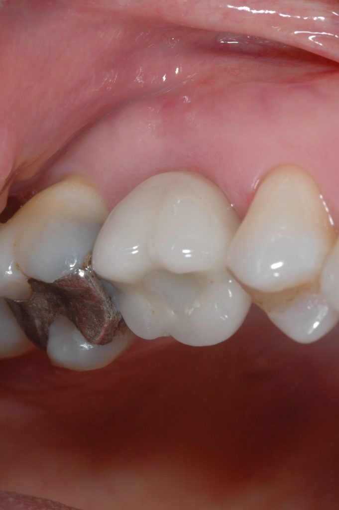 implant molar tooth single dental case implants